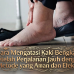 Cara Mengatasi Kaki Bengkak Setelah Perjalanan Jauh dengan Metode yang Aman dan Efektif