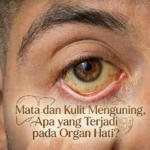Mata dan Kulit Menguning, Apa yang Terjadi pada Organ Hati?